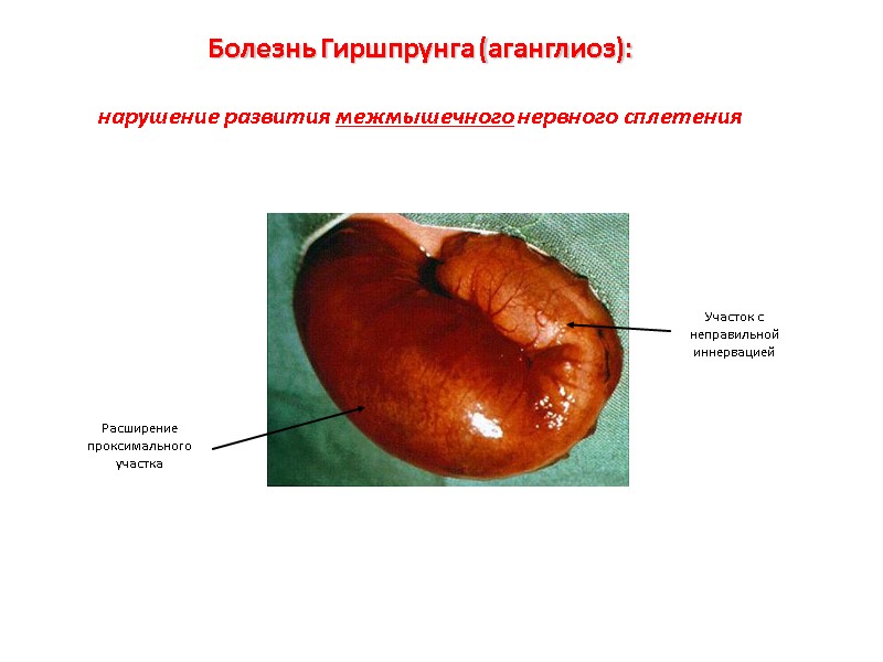 Болезнь Гиршпрунга (аганглиоз):   нарушение развития межмышечного нервного сплетения  Участок с неправильной
